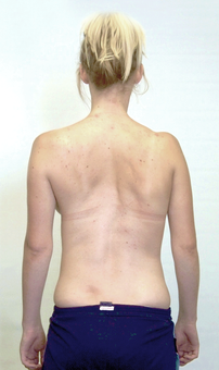 after intensive scoliosis treatment