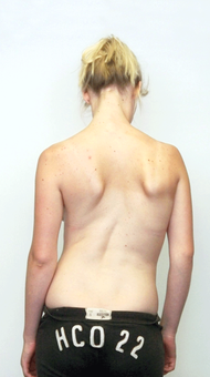 before scoliosis intensive treatment
