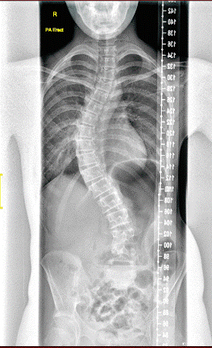 What Scoliosis Radiologists Should Know
