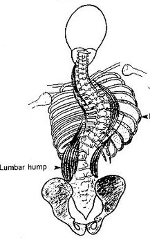 Thoracic hump, shoulder imbalance, lumbar hump were known as trunk deformities associated with scoliosis bothering patients.