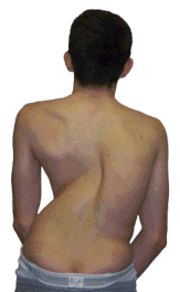 structural scoliosis - ANATOMICAL CHANGES OCCURRING